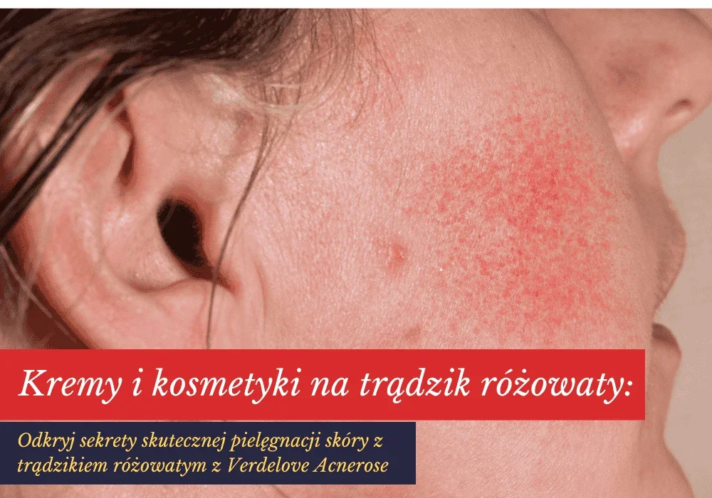 Kremy i kosmetyki na trądzik różowaty: Odkryj sekrety skutecznej pielęgnacji skóry z trądzikiem różowatym z Verdelove Acnerose